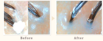 施術事例　30代女性（ｴｯｾﾝｽ塗布）